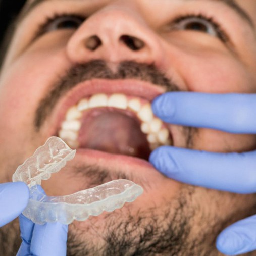 Active Aligners | Cleansmile