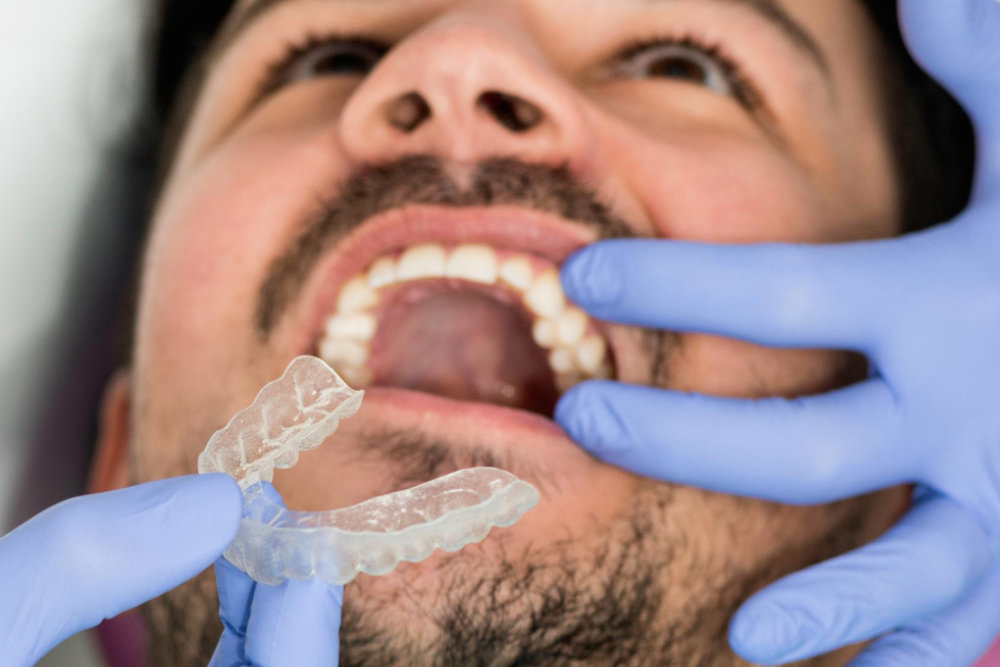 Active Aligners | Cleansmile