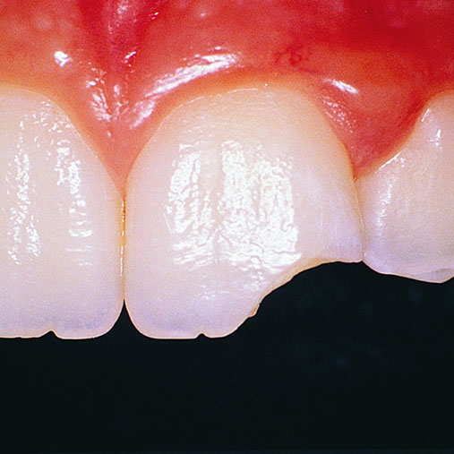 Broken Tooth Germiston | Cleansmile