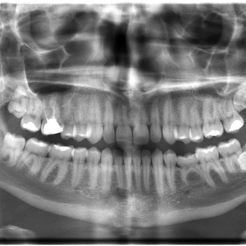 Dental X-Rays Germiston | Cleansmile