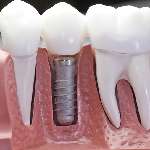 Loose Implants Germiston | Cleansmile